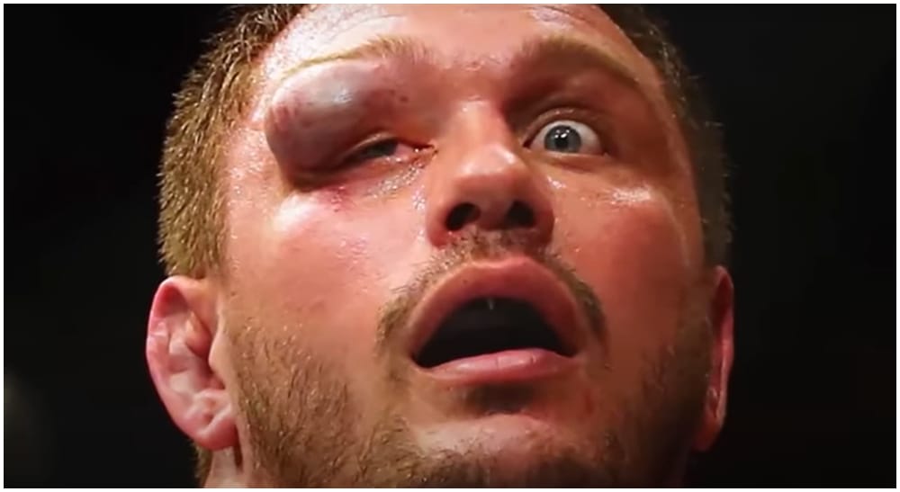 Matt Mitrione Brutal MMA injuries Frontkick.online